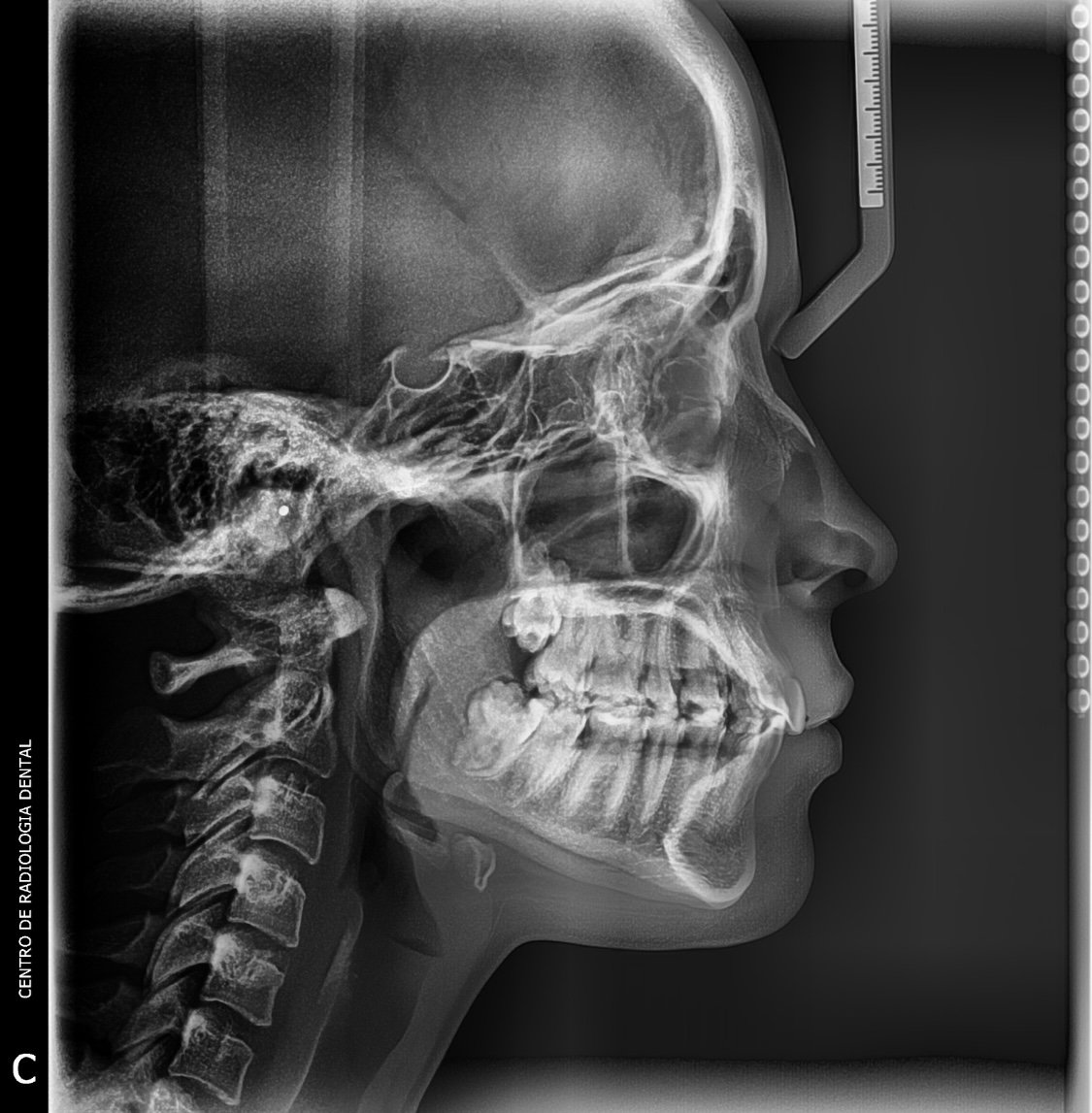 Imagen de Radiografía Lateral de Cráneo 