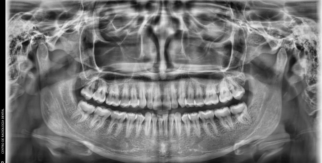 Imagen de Radiografía Panorámica (Ortopantomografía)