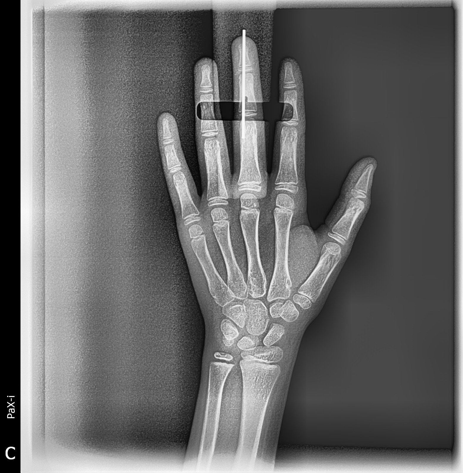 Imagen de Rx Carpal 